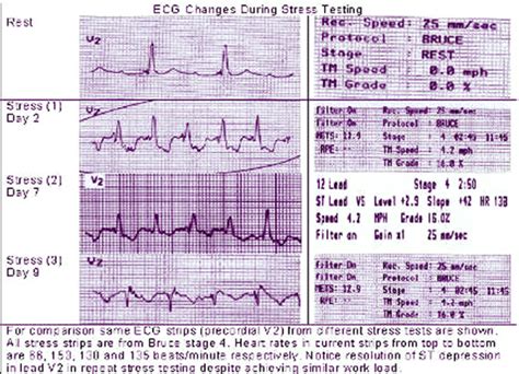 is stress test hard|abnormal ekg during stress test.